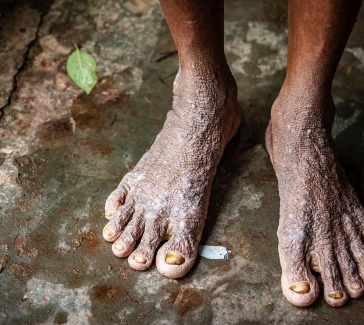 Abdul Hai, 59, has developed a skin condition from the flood water.
